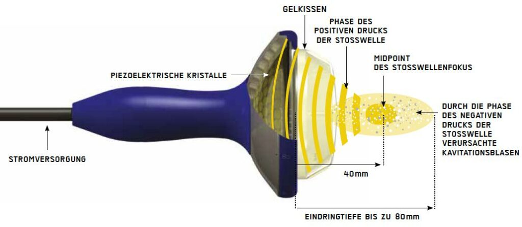 fokussiertes Handstück